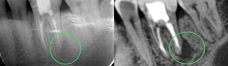 Cone Beam CT Scan vs. Traditional Dental Radiography