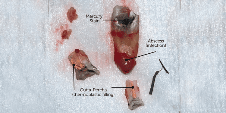 At Origin Dental Wellness, located in Tulsa, Oklahoma, our team of holistic dentists is dedicated to providing a comprehensive health-centered approach to oral care. We conduct thorough examinations of extracted tooth components, labeling areas such as "Mercury Stain," "Abscess (infection)," and "Gutta-Percha." This detailed analysis serves as an educational tool for our patients, enhancing their understanding of dental materials and conditions for better overall health.