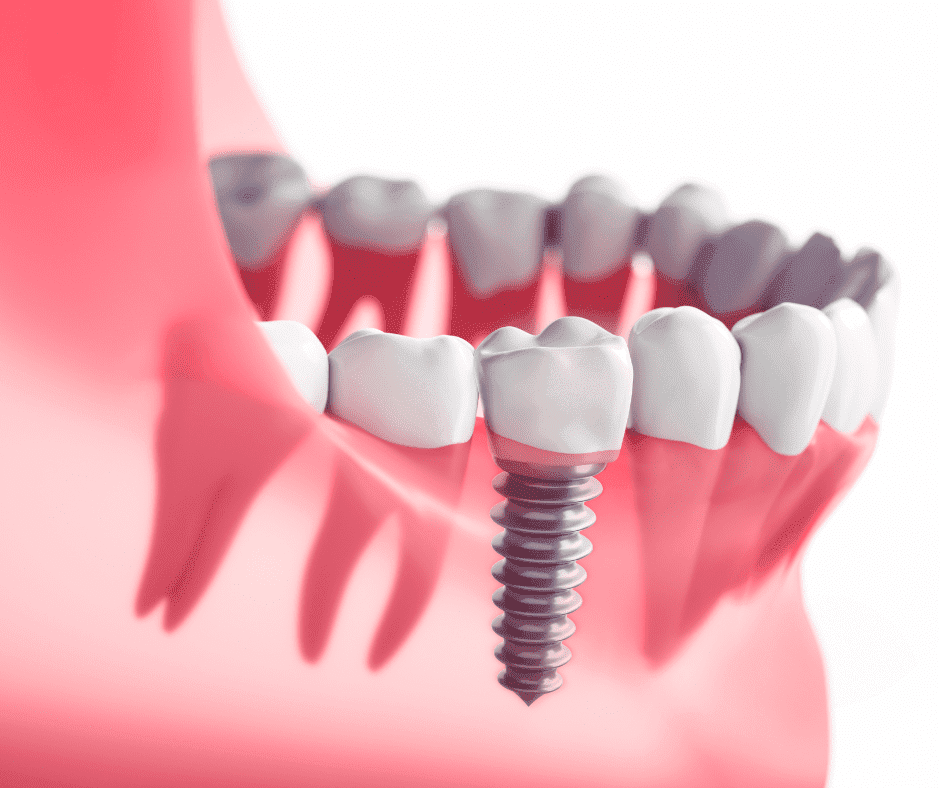 At Origin Dental Wellness, located in Tulsa, Oklahoma, experience the harmonious integration of advanced dental care and holistic health. Our detailed illustration reveals a dental implant seamlessly placed within the lower jaw amidst natural teeth and healthy gums. This visual representation underscores the proficiency and expertise of Tulsa's leading biological dentist, where we prioritize your overall well-being alongside your dental health.