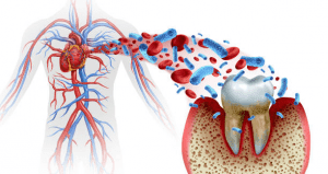 At Origin Dental Wellness, an insightful illustration demonstrates how bacteria from a tooth can enter the bloodstream, emphasizing the vital link between oral health and heart health. Schedule an appointment with your holistic, health-centered dentist in Tulsa, Oklahoma to learn more about nurturing your overall wellness.