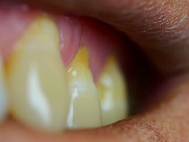 The Dangers of Root Exposure